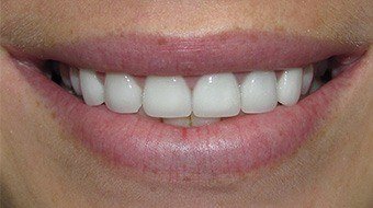 Closeup of Abby's smile after treatment