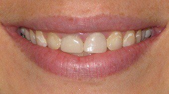 Closeup of Abby's smile before treatment