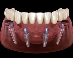 all on 4 dental implants
