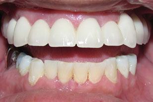 Flawlessly repaired smile after