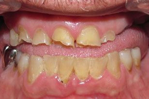 Severely damaged and decayded smile before