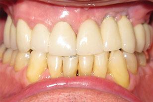 Natural looking implant prosthetic after