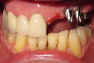 Numerous missing top teeth before