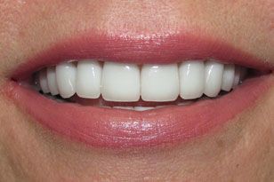 Bright white top front teeth after