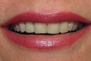Discolored top front teeth before