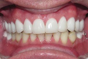 Reparied and cosmetically enhanced white smile after