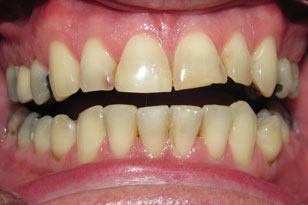 Severely damaged and discolored yellow smile before