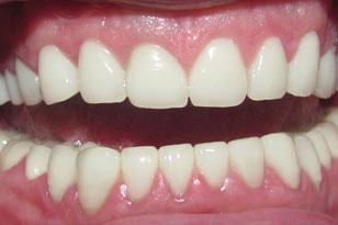 Flawless smile after full mouth restoration after