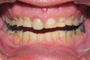 Full mouth decay and dental discoloration before