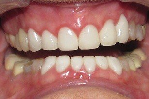White and healthy top and bottom teeth after