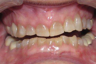 Yellow and damaged top and bottom teeth  before