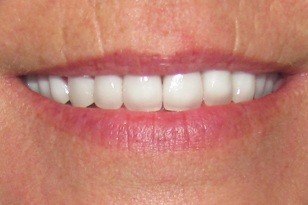 Yellowed tooth bright white after