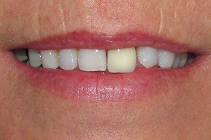 One yellow colored top front tooth before