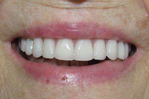 Natural looking denture after