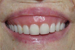 Unnatural looking oversized denture before