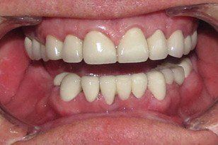 White healthy retored smile after