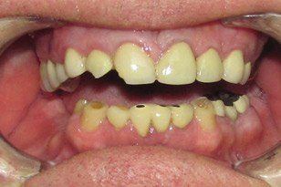 Yellow and damaged smile and missing teeth before