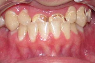 Severe overbite before treatment