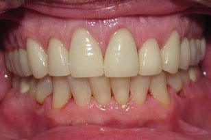 White smile after treatment