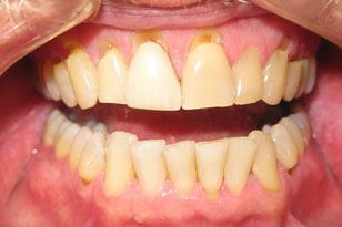 Yellow teeth before treatment