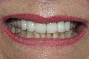 Closeup of beautiful white smile after