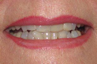 Closeup of discolored smile before