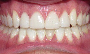 Properly spaced and brilliant white smile after