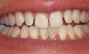 Unevenly spaced discolored smile