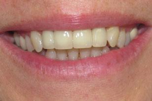 Repaired front tooth after treatment