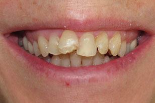 Chipped front tooth beforre treatment