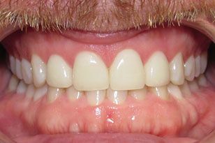 White healthy and evenly spaced teeth after