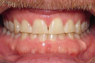 Yellow worn and unevenly spaced teeth before