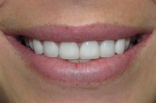 White teeth after