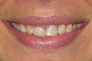 Discolored teeth before