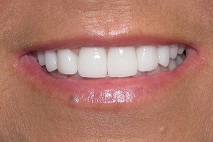 Flawlessly aligned smile and brilliant white teeth  after
