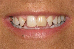 Unevenly spaced smile and dark colored front tooth before