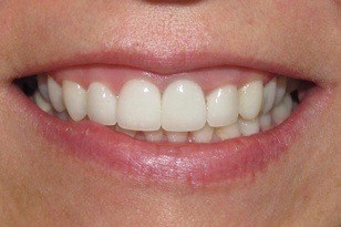 Closeup of smile with white front tooth after
