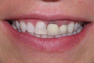 Closeup of smile with dark stained front tooth before