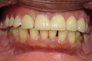 Gap between front teeth closed after