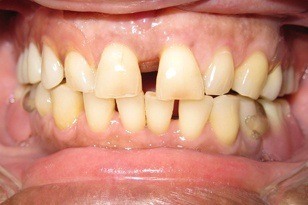 Large gap between front teeth before