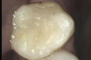 Large metal filling replaced with tooth colored restoration after
