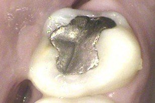 Tooth with large metal filling before