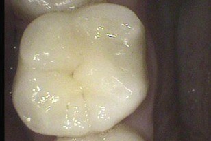 Closeup of tooth with natural looking filling after