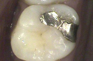 Closeup of tooth with small metal filling before