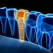 Translucent image of a dental implant