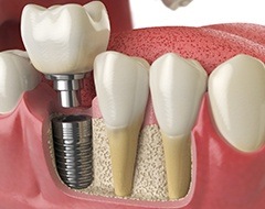 3D model of implant in the lower jaw