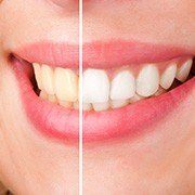 Closeup of smile half before and half after whitening