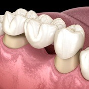 dental bridge in Oklahoma City 