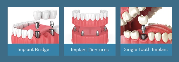 Chart with types of dental implants