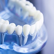A mouth mold that contains an implant bridge in Oklahoma City